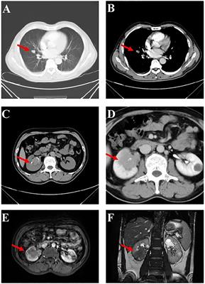 Case report: Innovative treatment for one metastatic thyroid-like follicular carcinoma of the kidney with ATM and POLE mutations